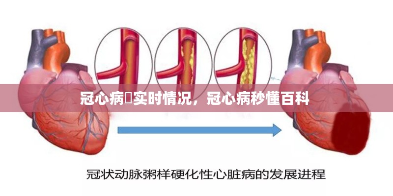 冠心病腅實(shí)時(shí)情況，冠心病秒懂百科 