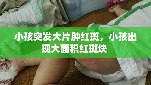 小孩突發(fā)大片腫紅斑，小孩出現(xiàn)大面積紅斑塊 
