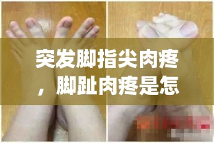 突發(fā)腳指尖肉疼，腳趾肉疼是怎么回事 