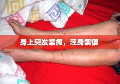 身上突發(fā)紫癜，渾身紫癜 