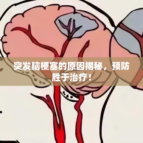 突發(fā)腦梗塞的原因揭秘，預(yù)防勝于治療！