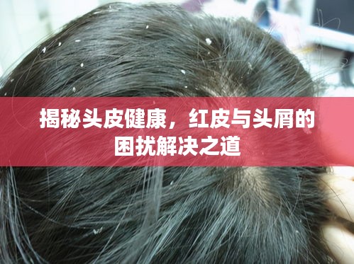揭秘頭皮健康，紅皮與頭屑的困擾解決之道