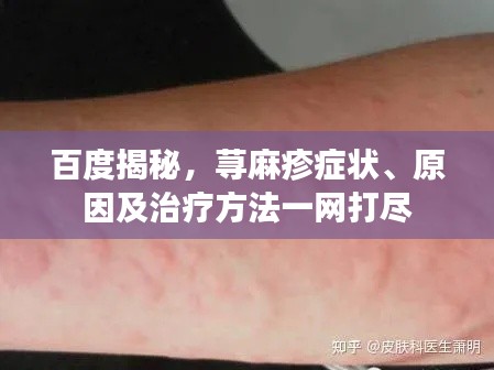 百度揭秘，蕁麻疹癥狀、原因及治療方法一網(wǎng)打盡