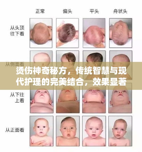 燙傷神奇秘方，傳統(tǒng)智慧與現(xiàn)代護理的完美結合，效果顯著！